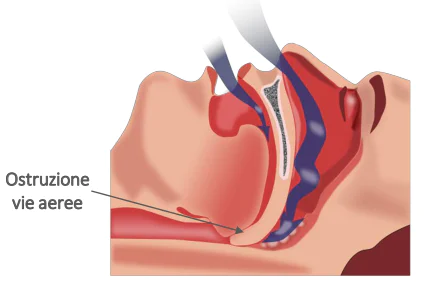 OSAS – Apnee ostruttive del sonno – Studio Medico Antium